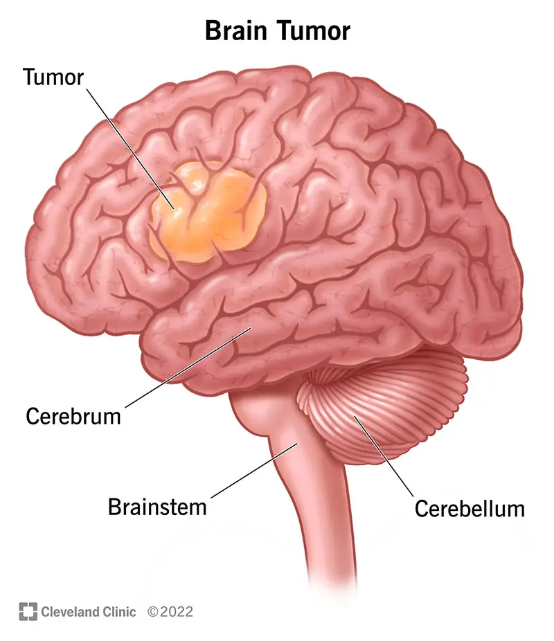 1705843345 6149 brain tumor