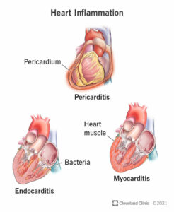 1705952960 23052 heart inflammation