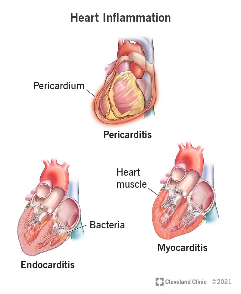 1705952960 23052 heart inflammation