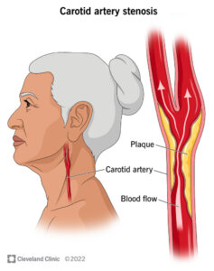 1705971256 16845 carotid artery stenosis