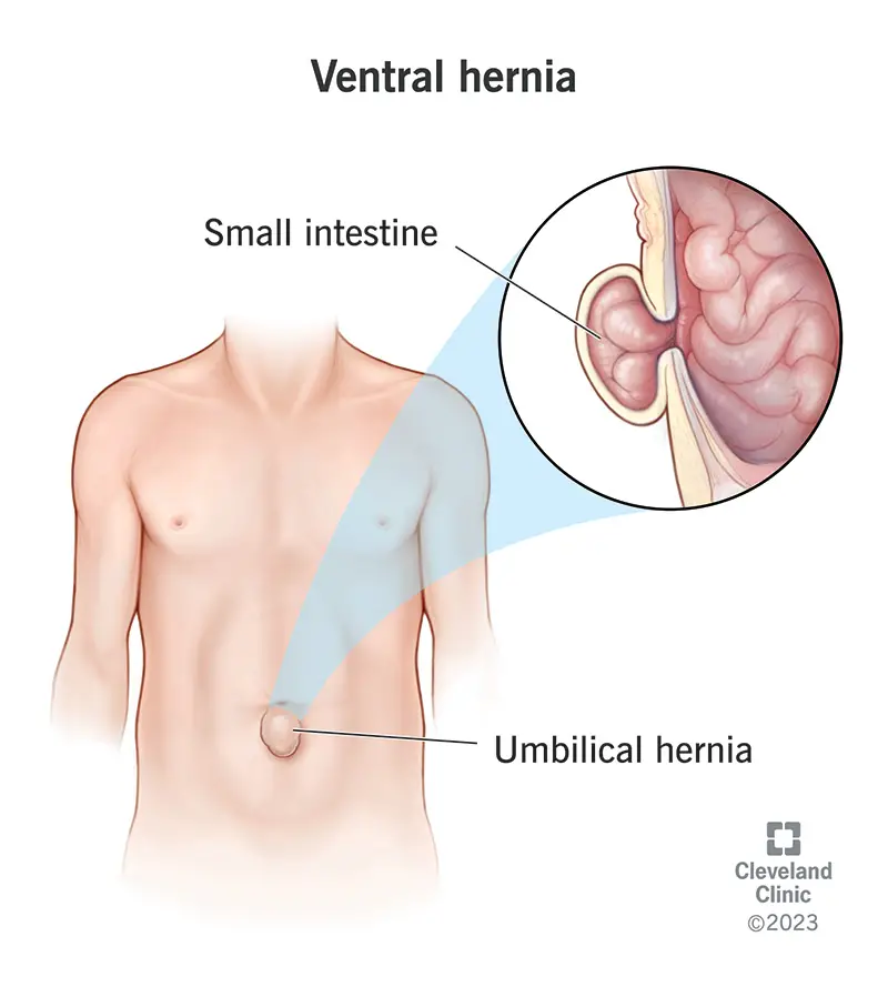 1705980438 16531 ventral hernia