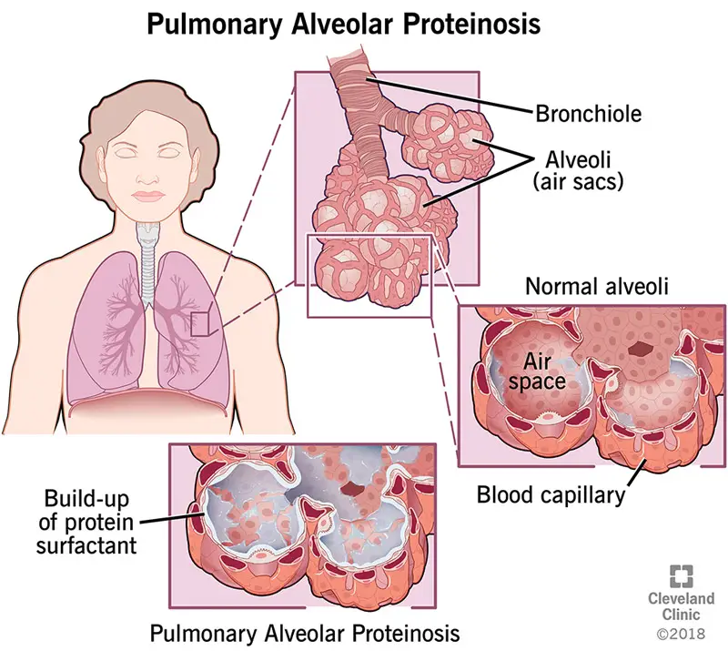 1705994123 17398 pulmonary alveolar proteinosis pap