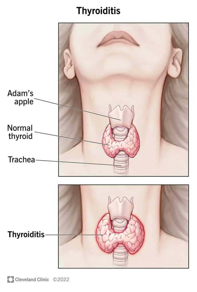 1706012363 15455 thyroiditis