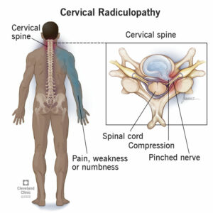 1706176886 22639 cervical radiculopathy