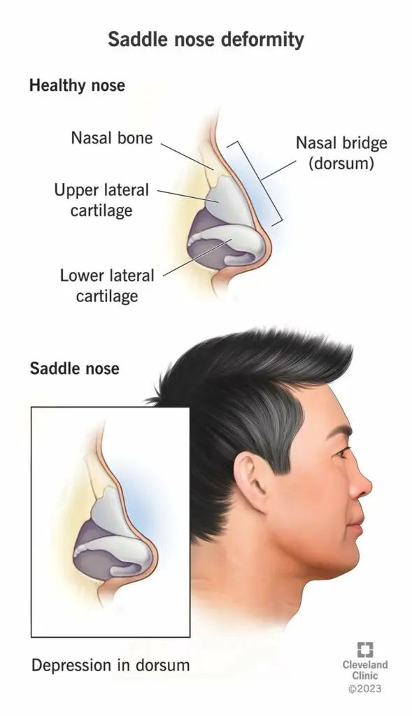 1706186005 24978 saddle nose