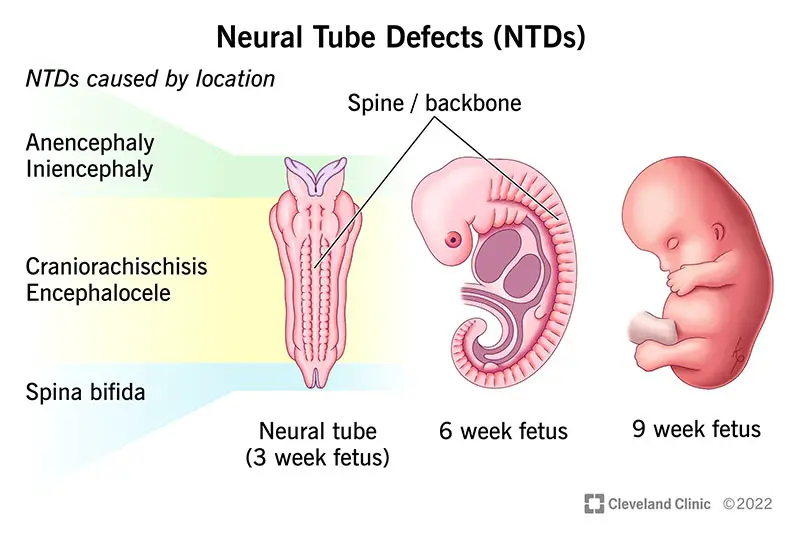 1706236338 22656 neural tube defects