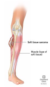 1706245464 21752 Soft Tissue Sarcoma Illustration