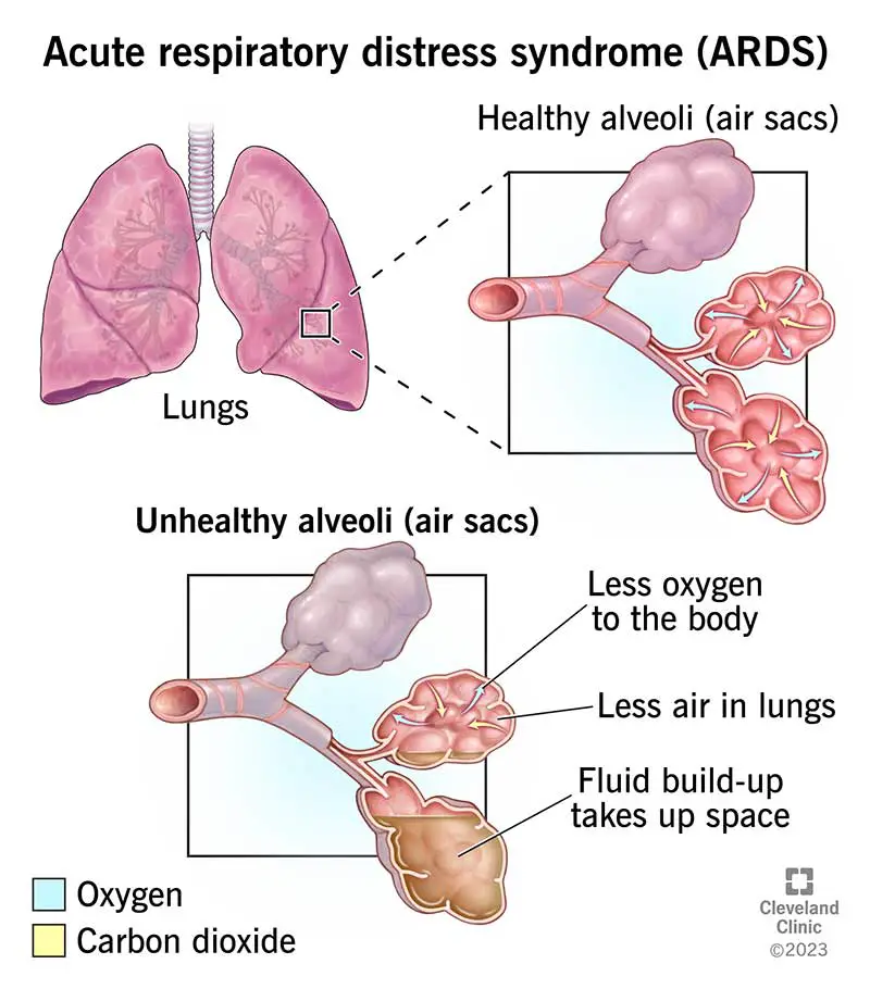 1706263704 acute respiratory stress syndrome