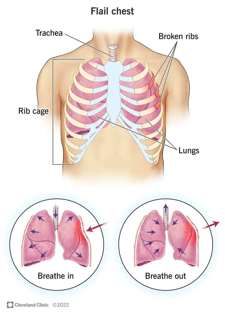 1706318413 23994 flail chest