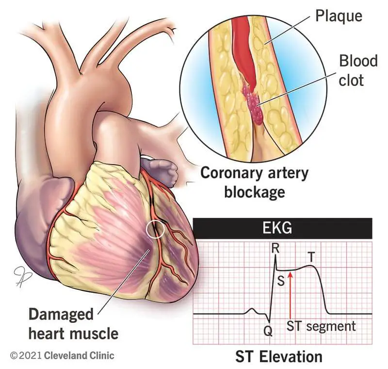 1706391501 22068 stemi heart attack illustration