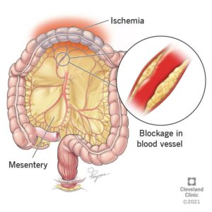 1706405241 23246 mesenteric ischemia