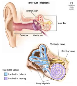 1706418976 24240 inner ear infections