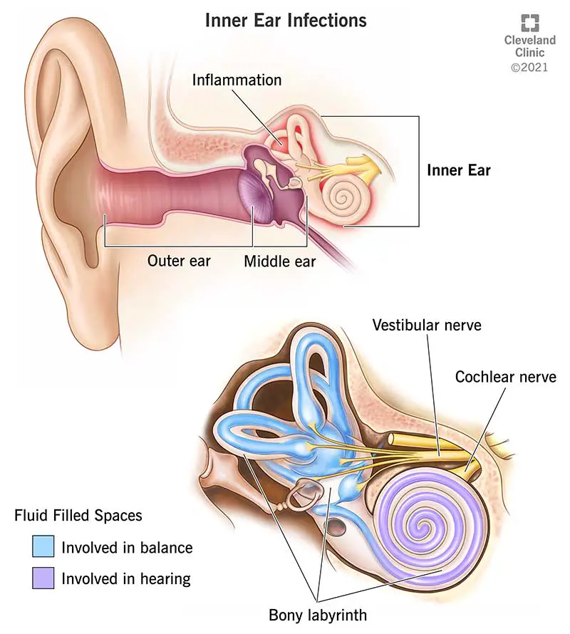 1706418976 24240 inner ear infections