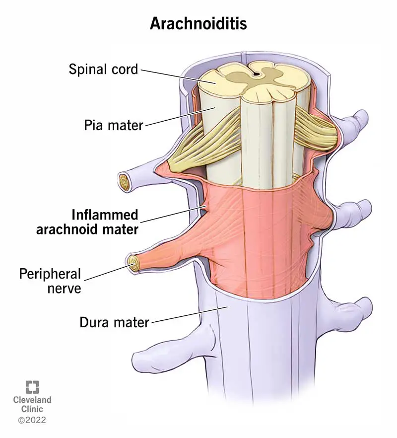 1706432776 12062 arachnoiditis