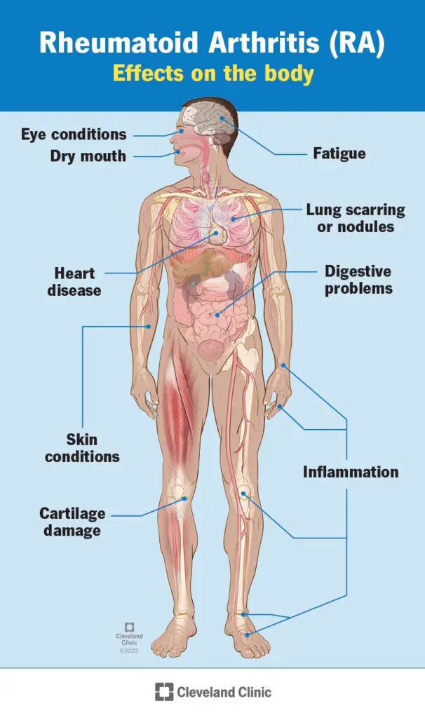 1706460146 4924 rheumatoid arthritis 2