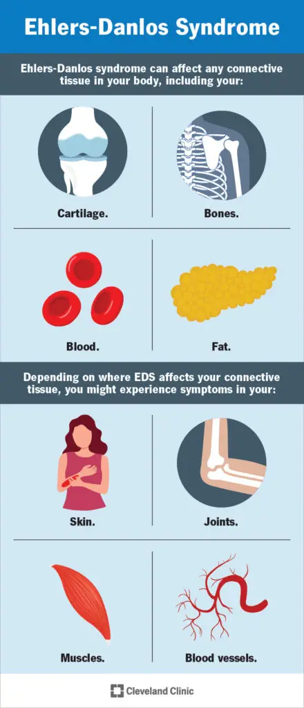 1706482939 17813 ehlers danlos syndrome