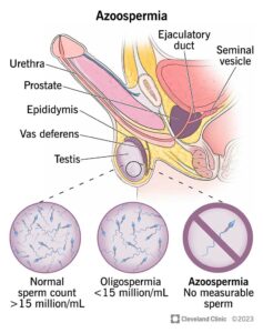 1706514984 15441 azoospermia