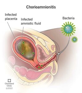 1706610744 12309 chorioamnionitis