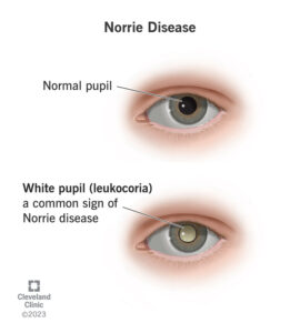 1706647226 25143 norrie disease