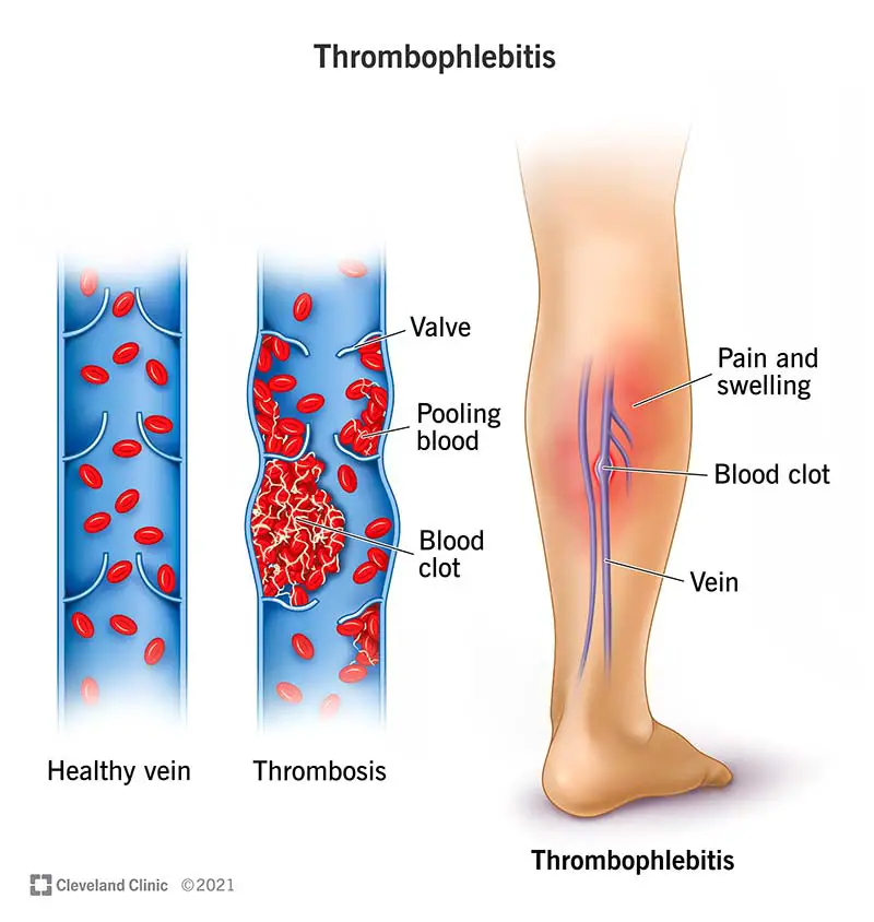 1706660961 23311 thrombophlebitis