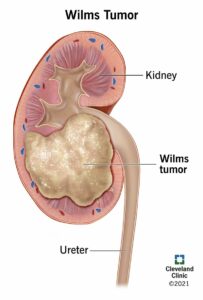 1706670079 23259 wilms tumor