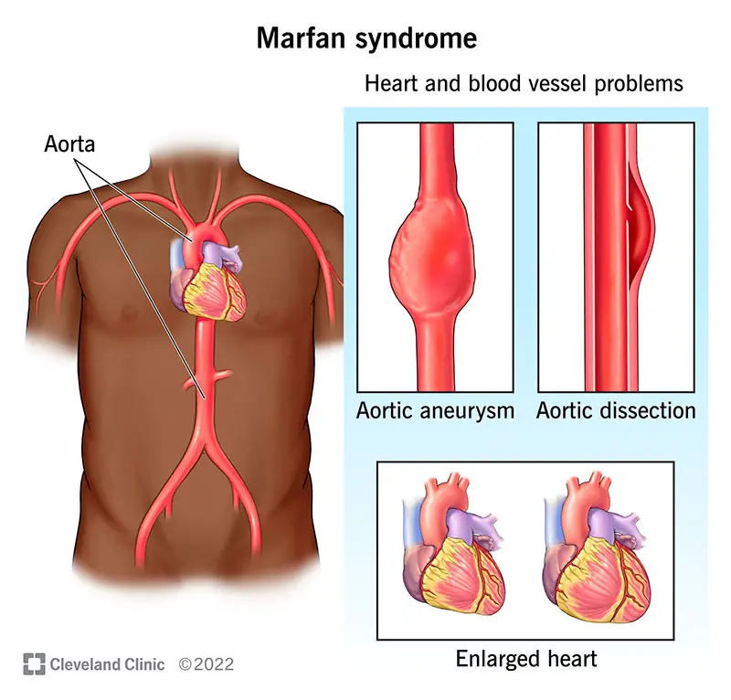 Cilvēkiem ar Marfana sindromu var būt palielināta sirds, un viņiem ir lielāks aortas aneirisma un aortas sadalīšanās risks.