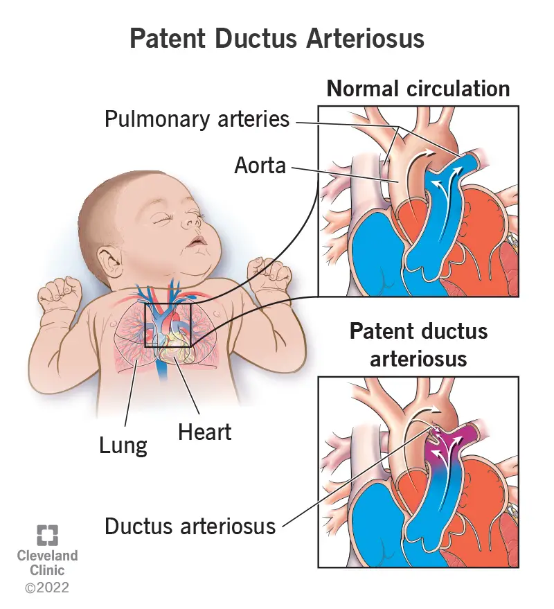 Atvērtā arteriozā kanālā neliela atvere ļauj papildu asinīm no aortas iekļūt bērna plaušu artērijās.