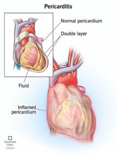 17353 pericarditis