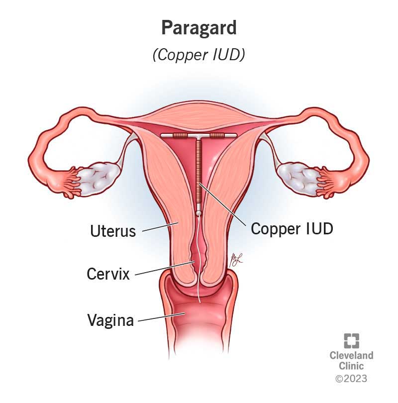 T-veida vara IUD dzemdes iekšpusē.