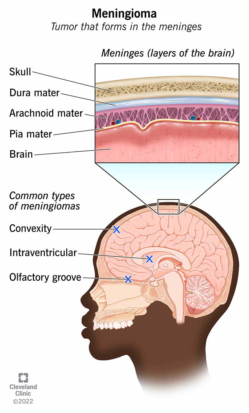 Bieži sastopami meningiomu veidi ir izliekums, intraventrikulāra un ožas rieva.