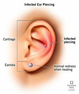 21503 infected ear piercing