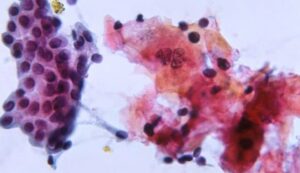 21714 cytology cdc image