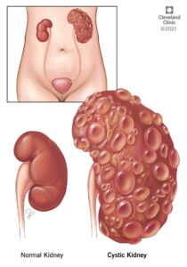 21846 cystic kidney disease