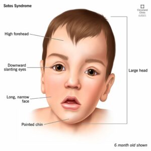 22177 sotos syndrome