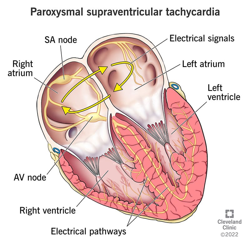 22232 paroxysmal supraventricualar tachycardia psvt