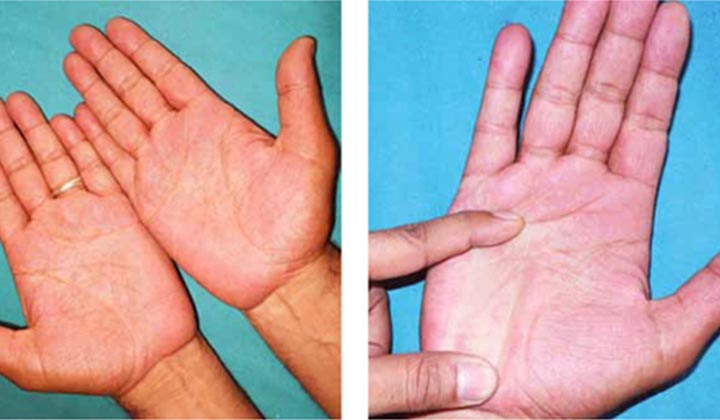 22752 erythromelalgia