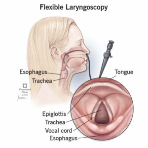 22803 laryngoscopy
