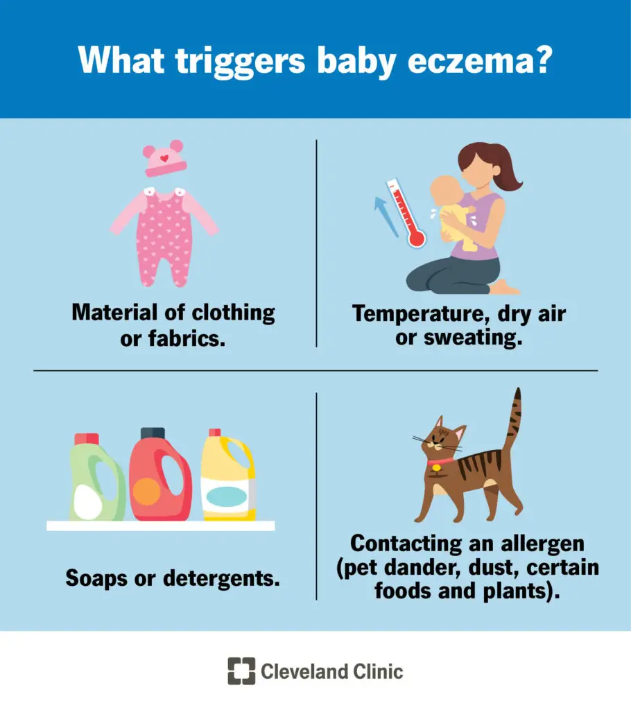 23408 baby eczema