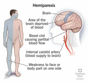 24952 hemiparesis