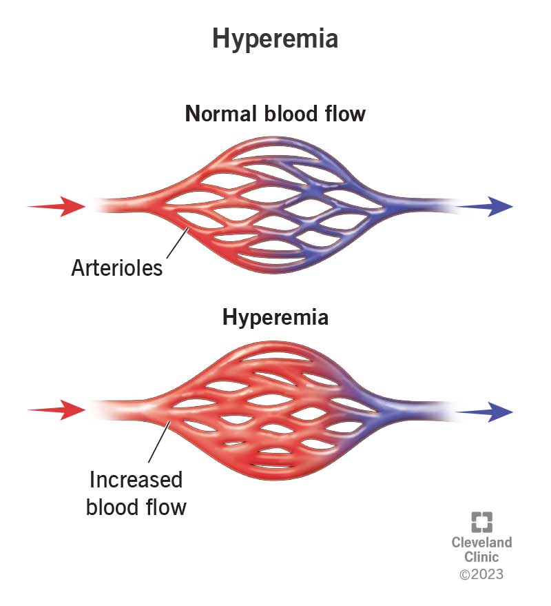 24986 hyperemia