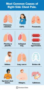 25070 right side chest pain cv