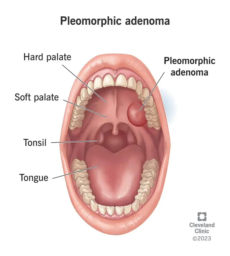 Pleomorfā adenoma (labajā pusē) ir labdabīgs (nevēža) audzējs, kas var veidoties uz jūsu siekalu dziedzeriem.