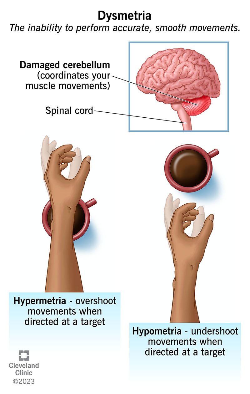 Dismetrija: rokas pārspīlēšana (hipermetrija) un zema (hipometrija) stiepšanās pēc kafijas tases.
