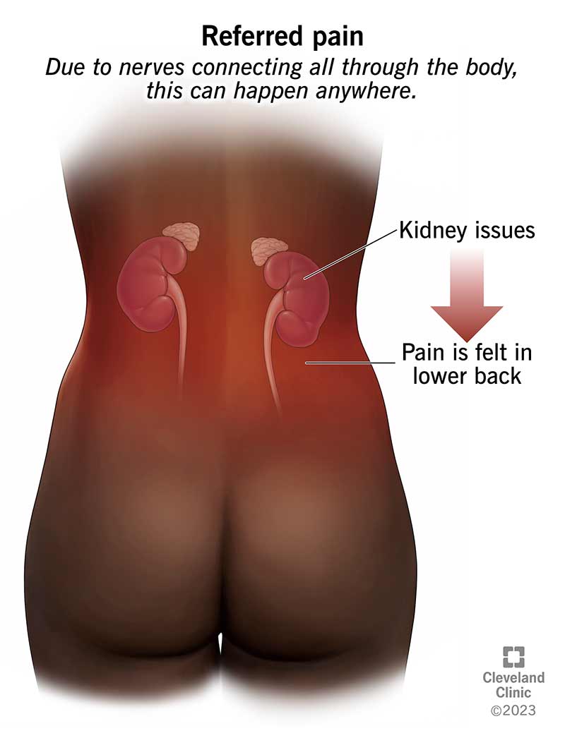 Diagramma, kurā parādīta nieru atrašanās vieta (muguras vidusdaļā) un vieta, kur ir jūtamas minētās sāpes (muguras lejasdaļa).