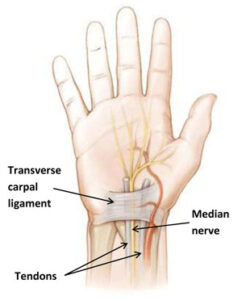 4005 carpal tunnel