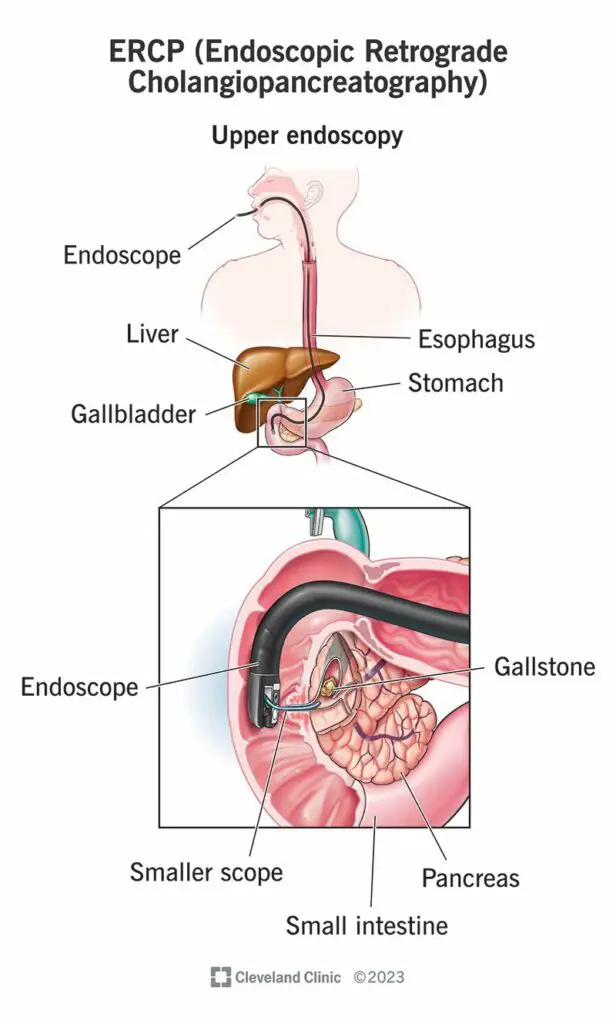 4951 ercp