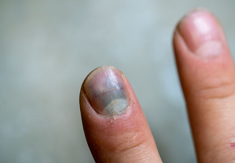 FingernailBruise 1227060560 770x533 1