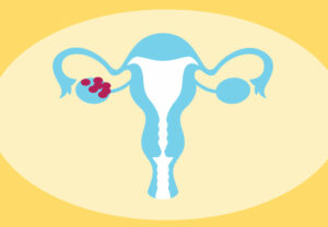 PCOS uterusOvaries 883164360 770x533 1