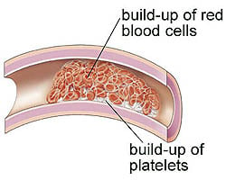 blood clotting