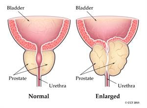 normāla un palielināta prostata